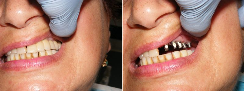 השתלת שיניים - לפני ואחרי (צילום: יח"צ דנטל קליניק)